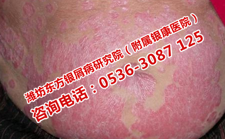 遠(yuǎn)離牛皮癬的方法會(huì)什么